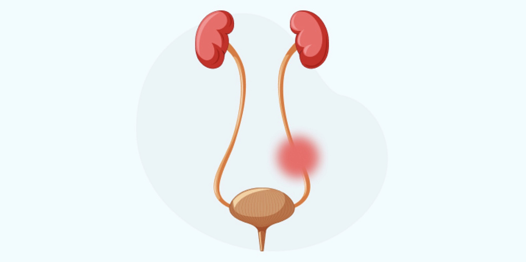 Уретроцеле