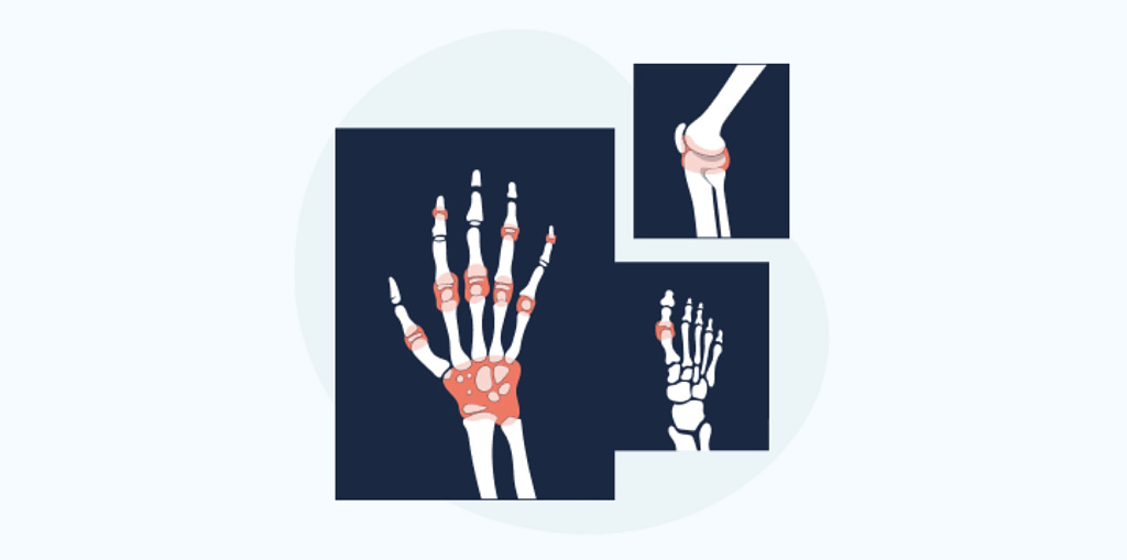 Артрогрипоз