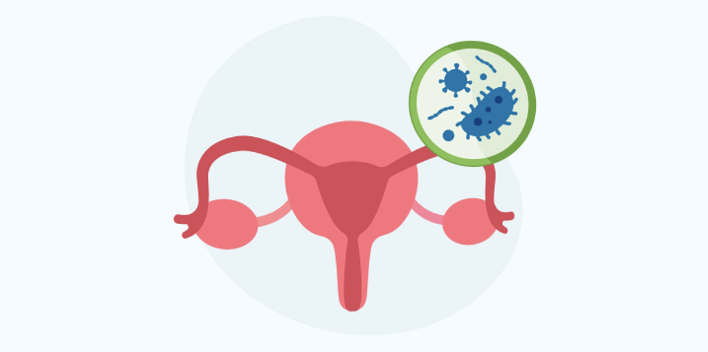 Уреаплазмоз