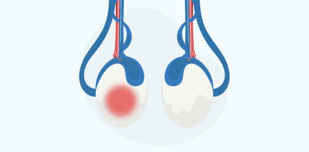 Орхоэпидидимит