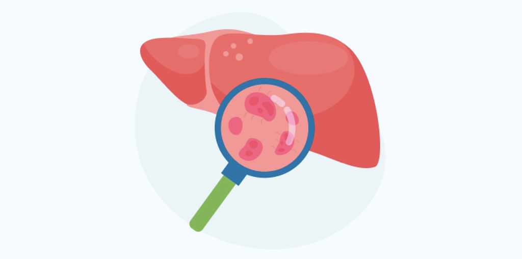 Гепатит А у детей