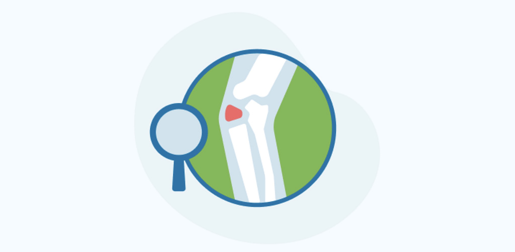 Хондроматоз