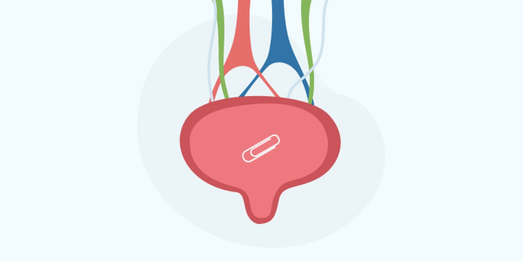 Инородное тело мочевого пузыря