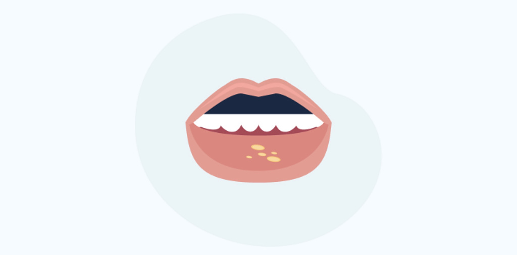 Афтозный стоматит у детей