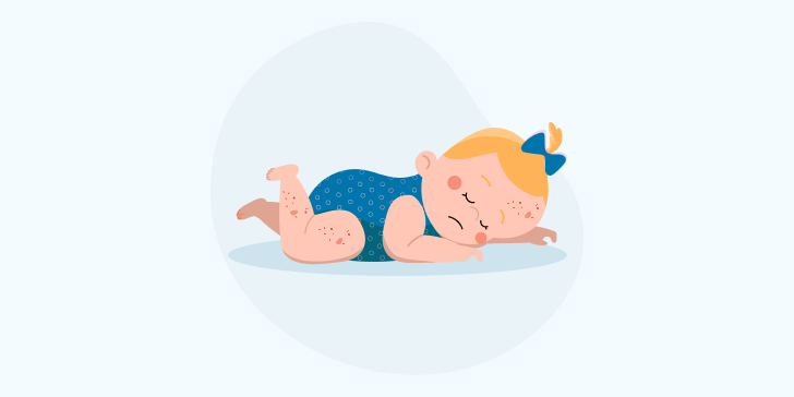 Чесотка у детей