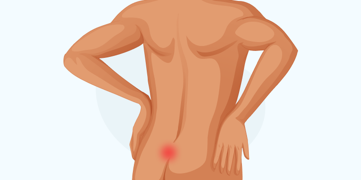 Эпителиальный копчиковый ход