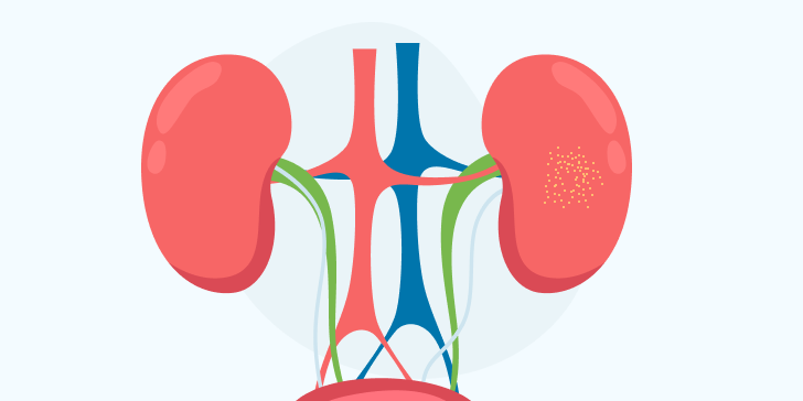 Песок в почках