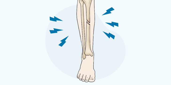 Закрытый перелом