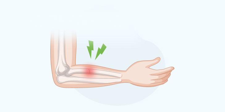 Переломы предплечья