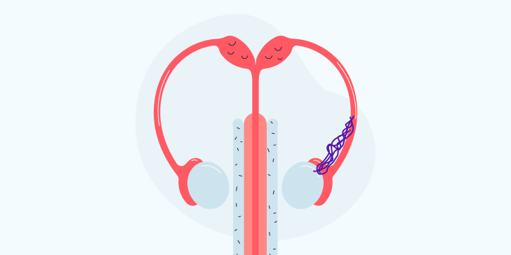 Удаление варикоцеле