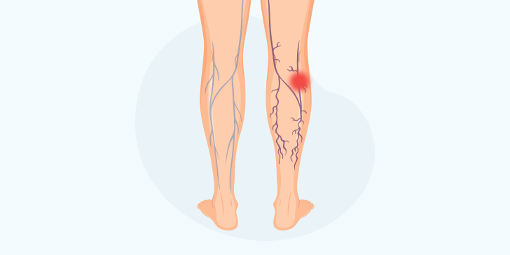 Тромбофлебит