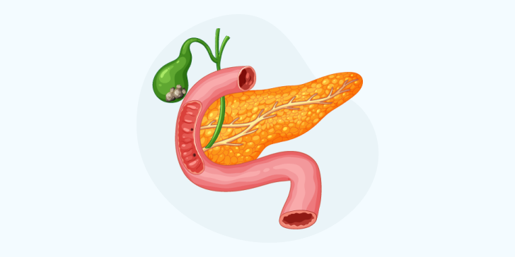 Желчнокаменная болезнь (ЖКБ)