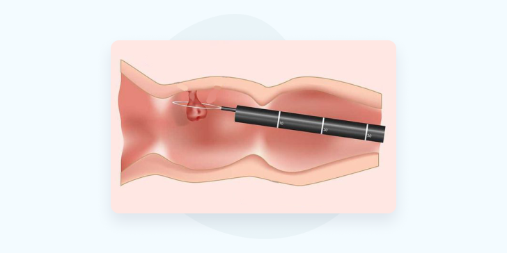 Полип толстой кишки