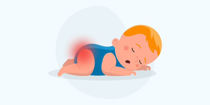 Пеленочный дерматит у детей