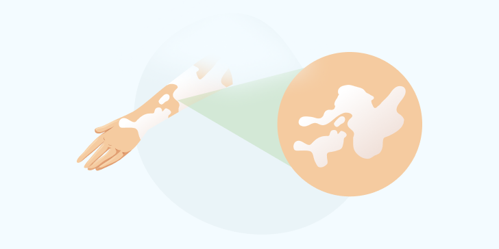 Витилиго у детей