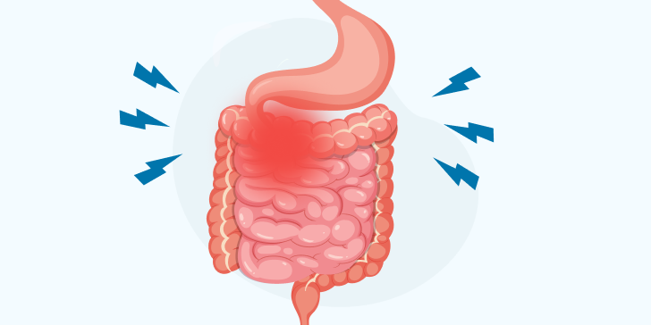 Прободная язва двенадцатиперстной кишки