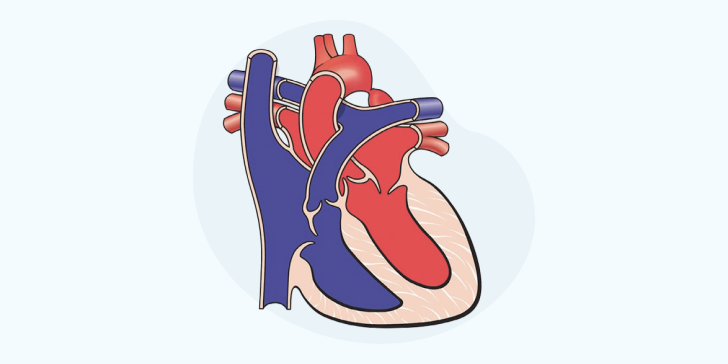 Коарктация аорты