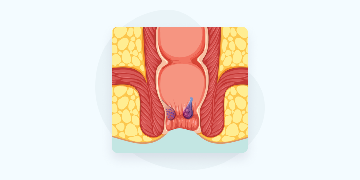 Внутренний геморрой