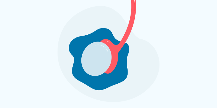 Гидроцеле (водянка яичка)