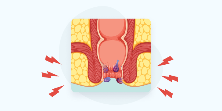 Острый геморрой 
