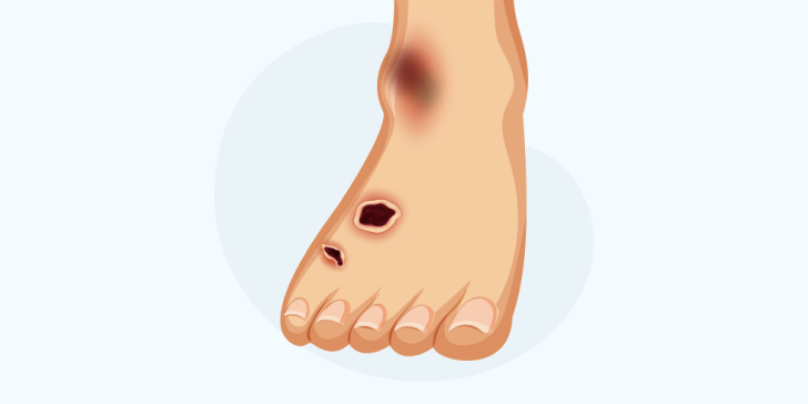 Диабетическая стопа