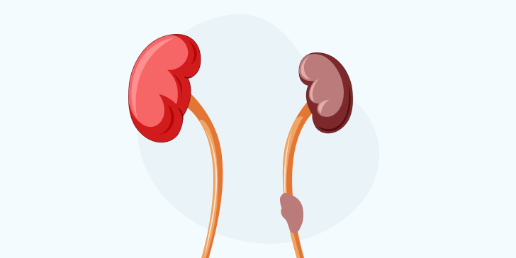 Гидронефроз