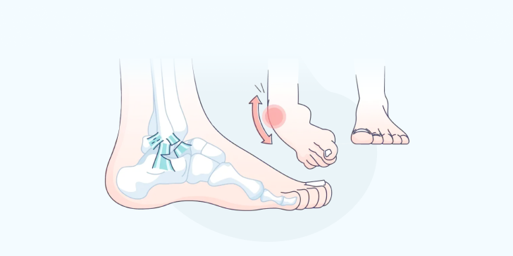 Растяжение связок голеностопного сустава
