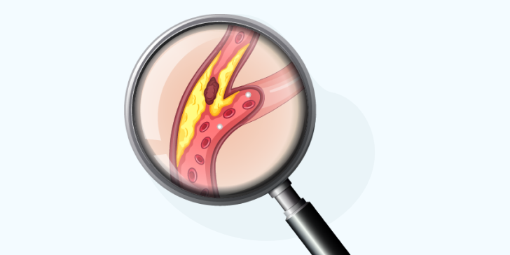 Облитерирующий атеросклероз