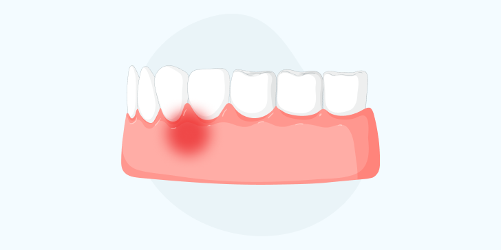 Киста на десне у детей