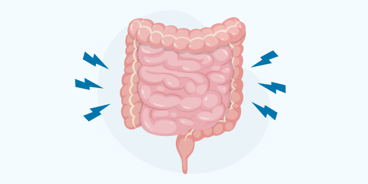 Спаечная кишечная непроходимость