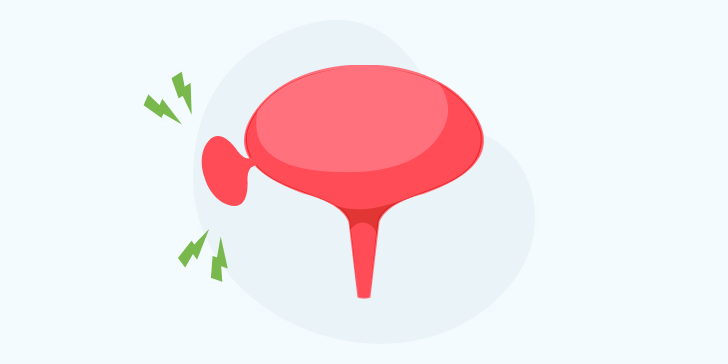 Дивертикул мочевого пузыря