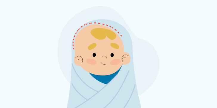 Плагиоцефалия у ребенка