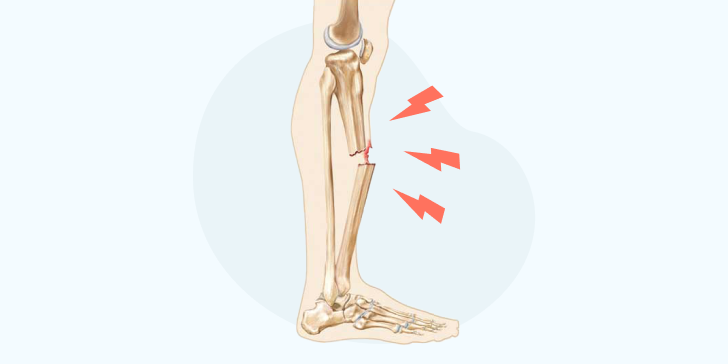 Открытый перелом ноги