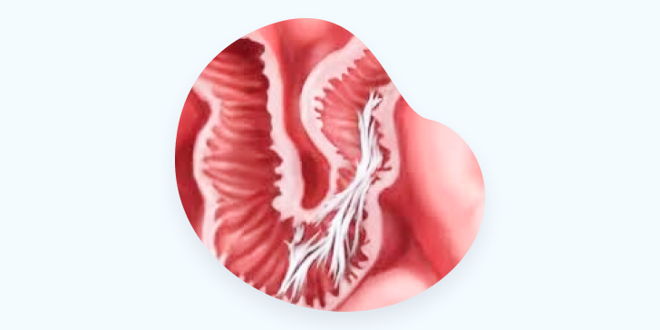 Спаечная болезнь