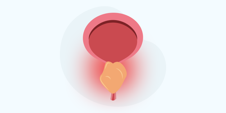 Острый простатит