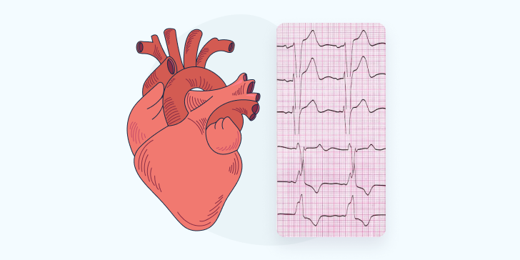 Блокада ножек пучка Гиса