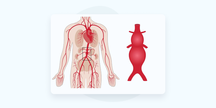 Аневризма брюшной аорты