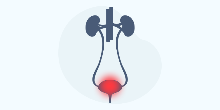 Интерстициальный цистит