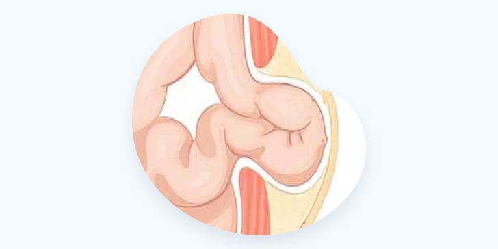Пупочная грыжа