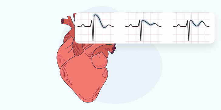 Синдром Бругада