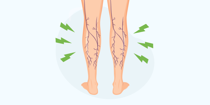 Тромбоз глубоких вен нижних конечностей