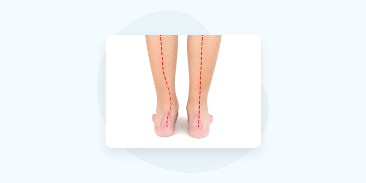 Вальгусная деформация стопы у детей