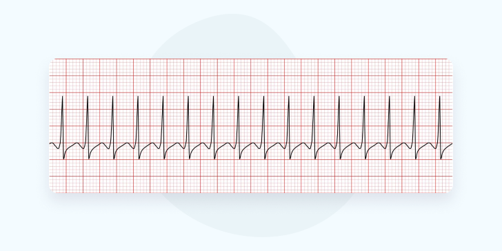 Наджелудочковая тахикардия