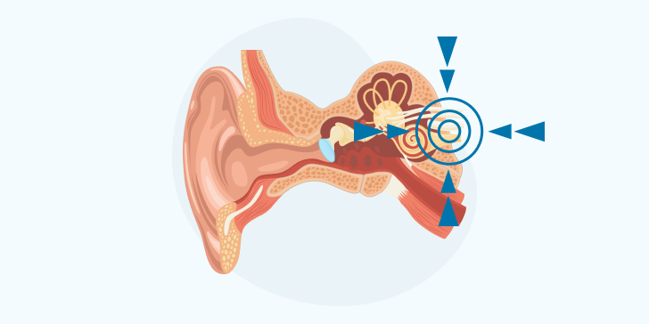 Невринома слухового нерва