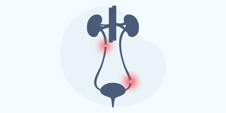 Камни в мочеточнике