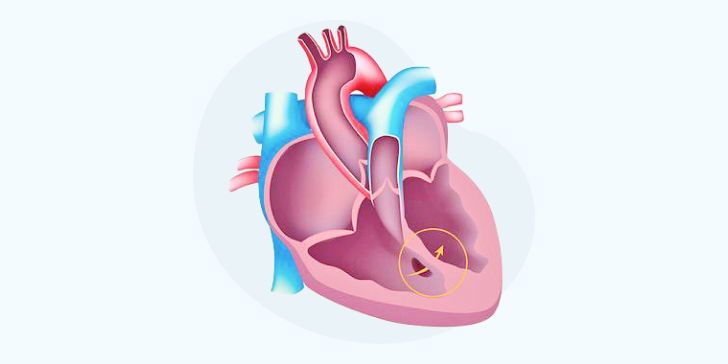 Дефект межжелудочковой перегородки