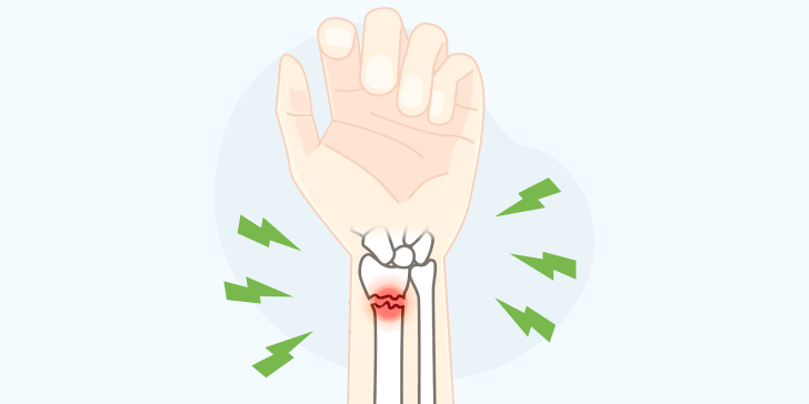 Проксимальный перелом лучевой кости