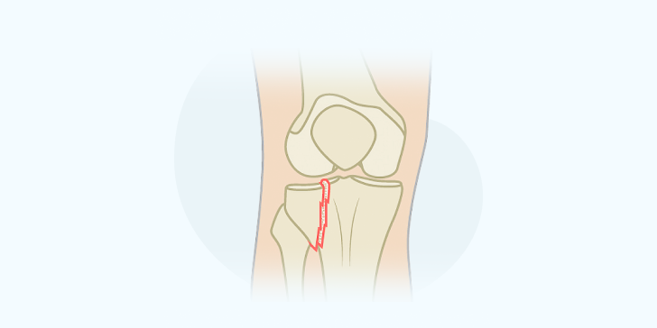 Внутрисуставной перелом
