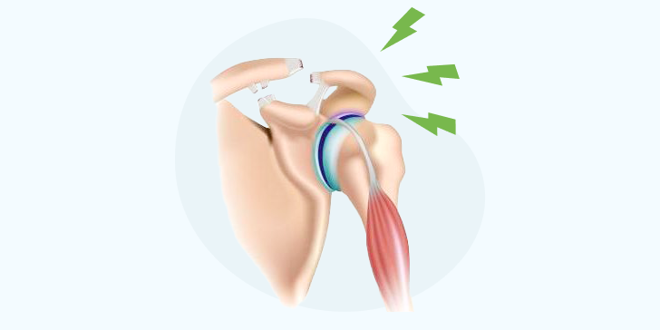 Разрыв связок плечевого сустава