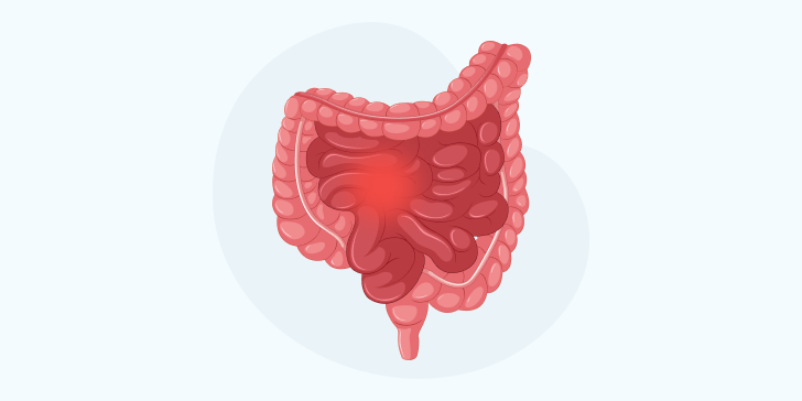 Дивертикул Меккеля